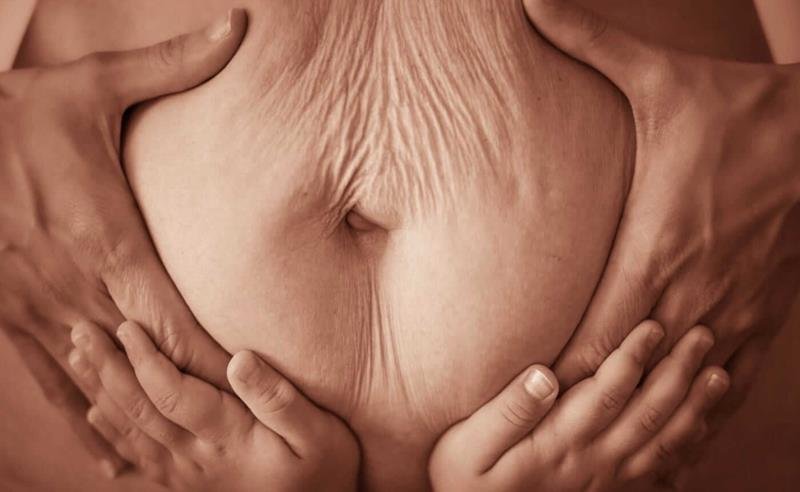 Dr. Octávio Curi Frascareli: Abdominoplastia pós-gestação: quando o corpo não retorna apenas com exercícios
